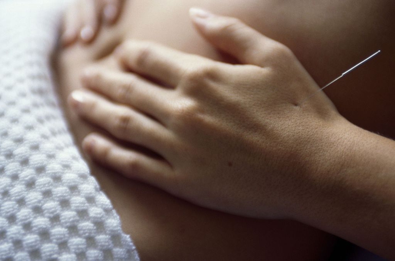 agopuntura mano
