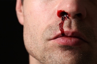 Sangue dal naso: cause tipiche e rimedi naturali per l’epistassi