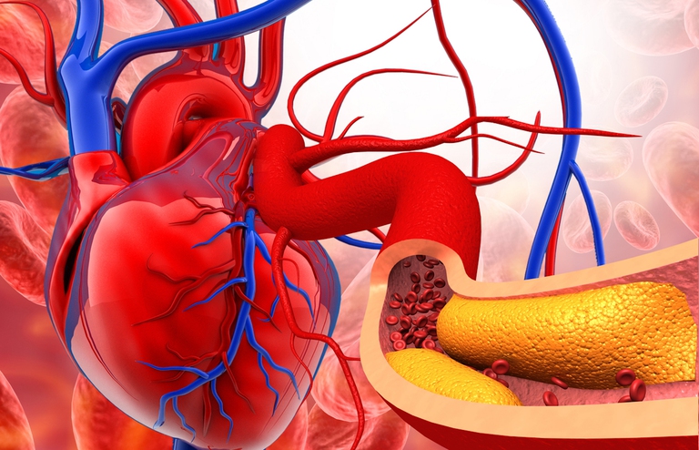 microplastiche arterie
