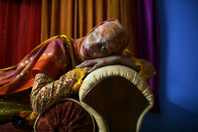 Violenza contro le donne in Asia del sud. Pakistan sopravvissuta ad attacco con l'acido