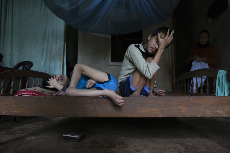 Bambini vietnamiti vittime di gravi disabilità a causa degli effetti della diossina