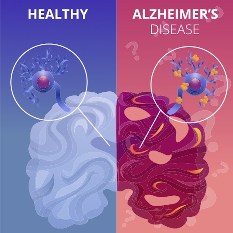 alzheimer